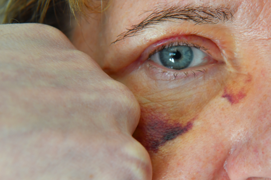 Vor einer Lokalität in der Schwalbacher Straße in Wiesbaden ist am Sonntagmorgen ein 21-jähriger Wiesbadener leicht verletzt worden. Ein bislang unbekannter Täter schlug dem Mann unvermittelt ins Gesicht und flüchtete anschließend in Richtung Rheinstraße.